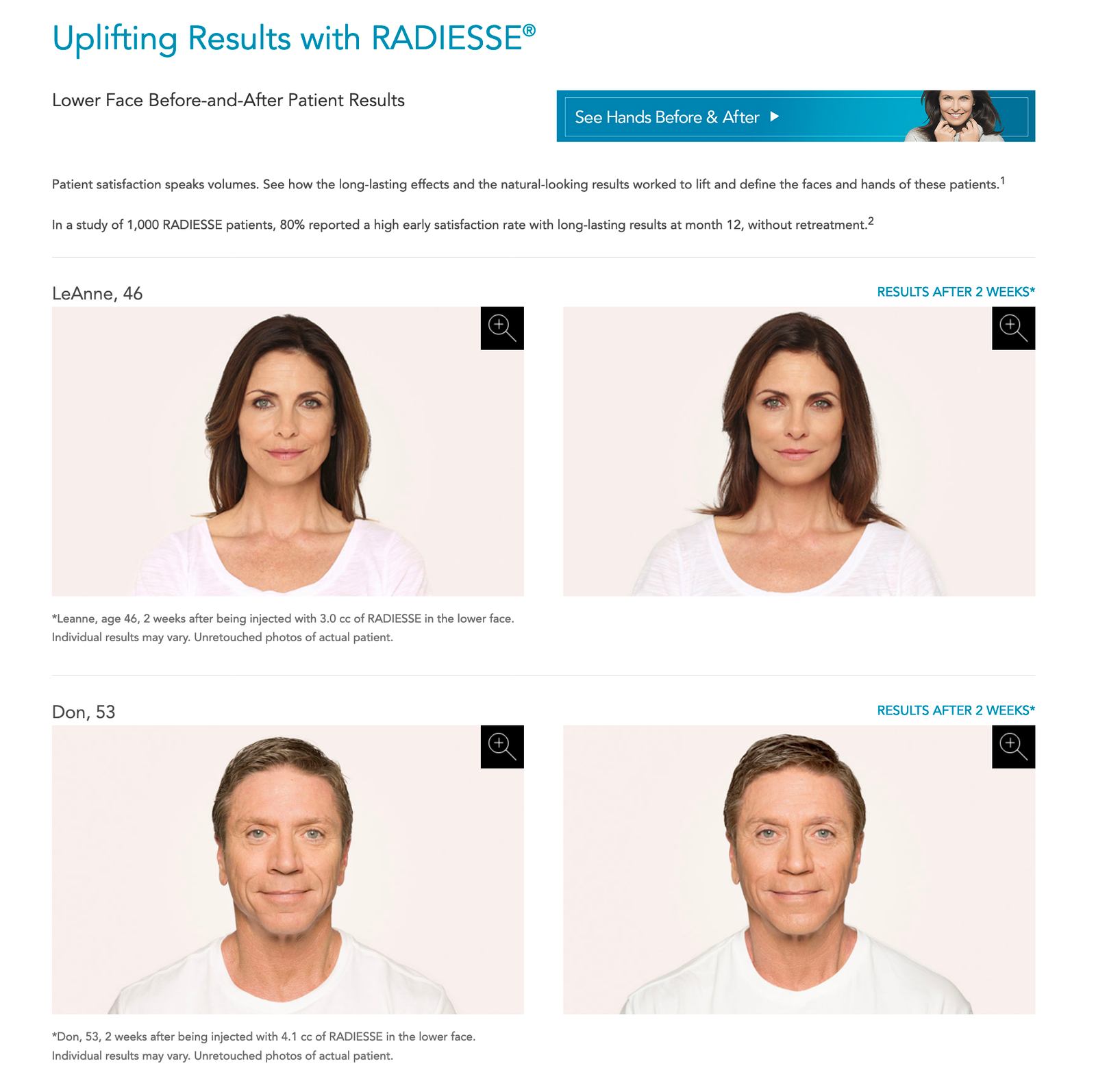 radiesse-torrance-before-after